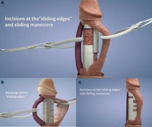 prosthesis الجراحة بالزراعة